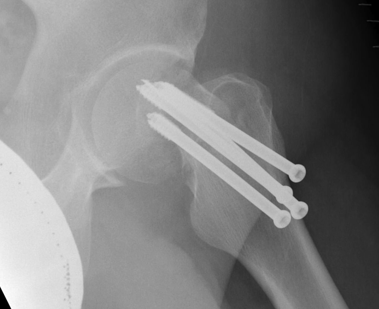 Subcapital ORIF Lateral